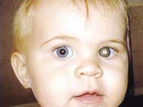 1岁宝宝眼睛反光摘除眼球,医生向所有父母发出